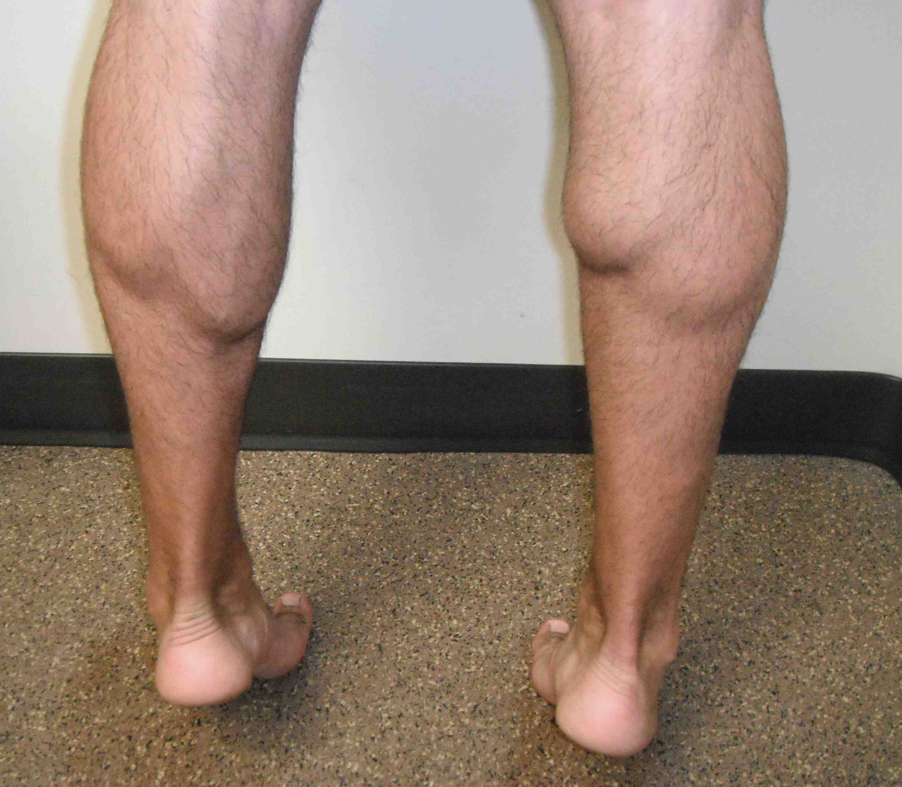 Medial Head Gastrocnemius Rupture